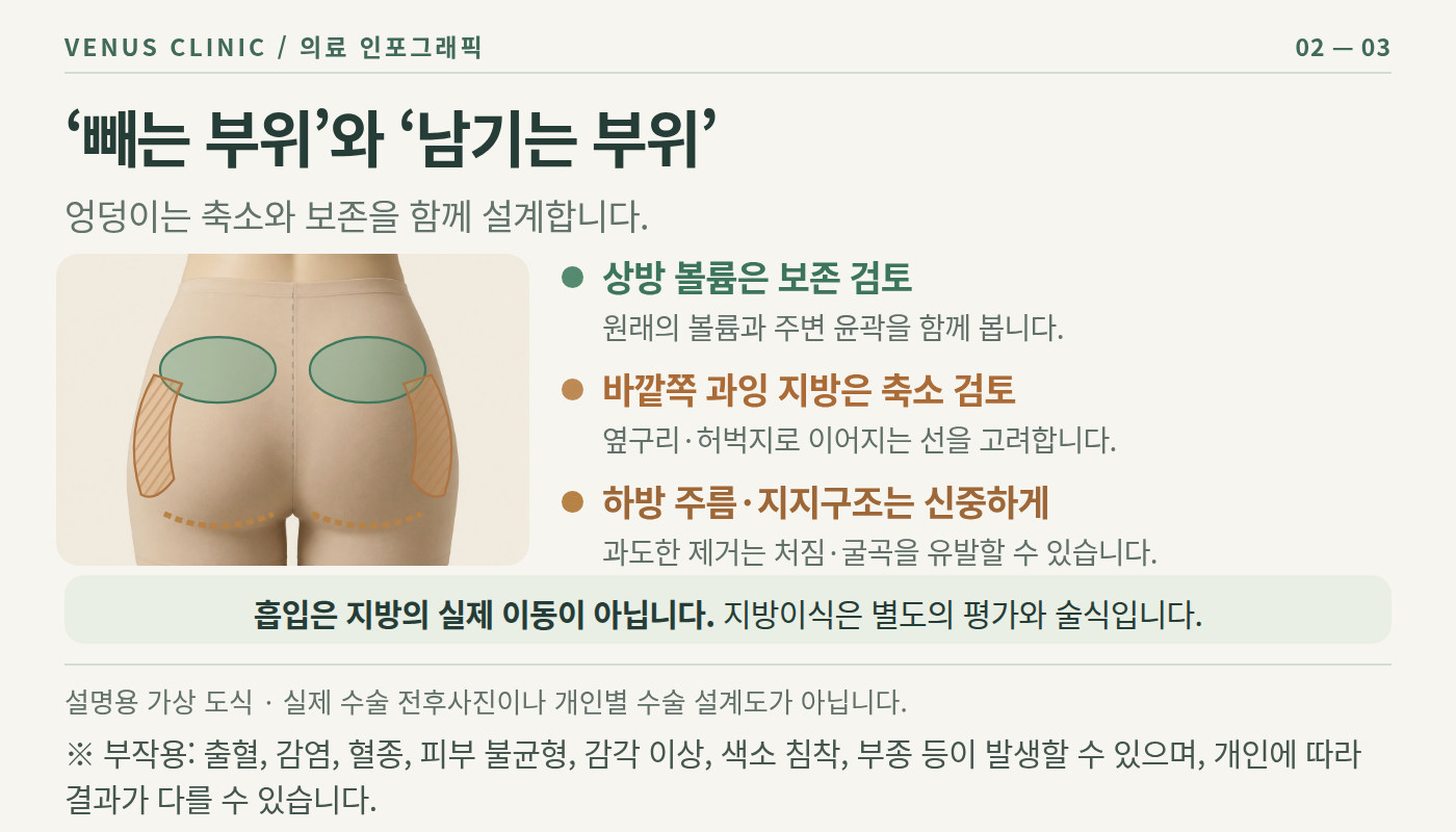 엉덩이축소 지방흡입 캐뉼라 디자인 볼륨 재배치 원리 도식