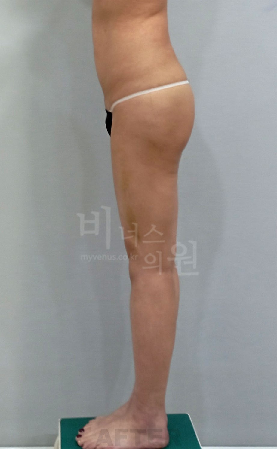 엉덩이축소 지방흡입 수술 후 우측면 비너스의원