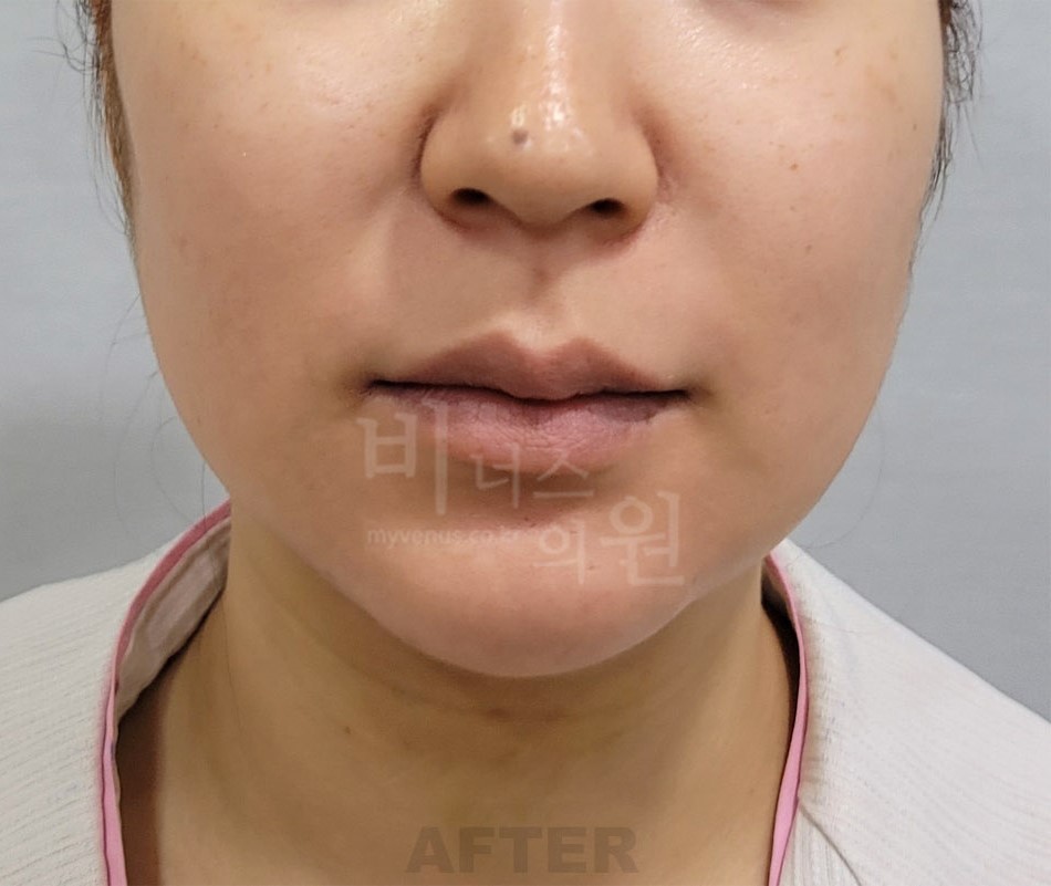 턱 지방흡입 수술 후 정면 비너스의원