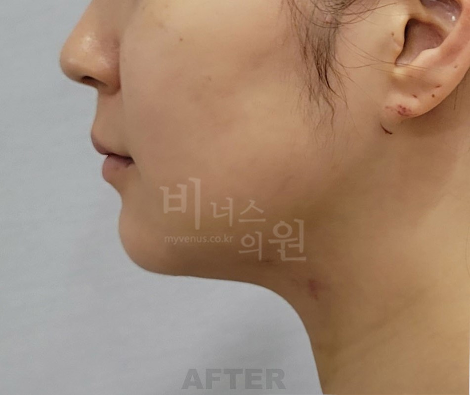 턱 지방흡입 수술 후 우측면 비너스의원