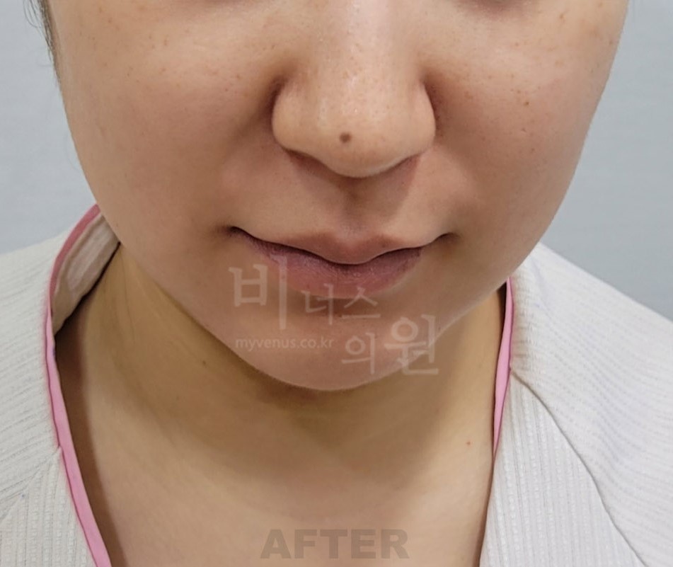 턱 지방흡입 수술 후 정면 — 턱을 든 자세 비너스의원