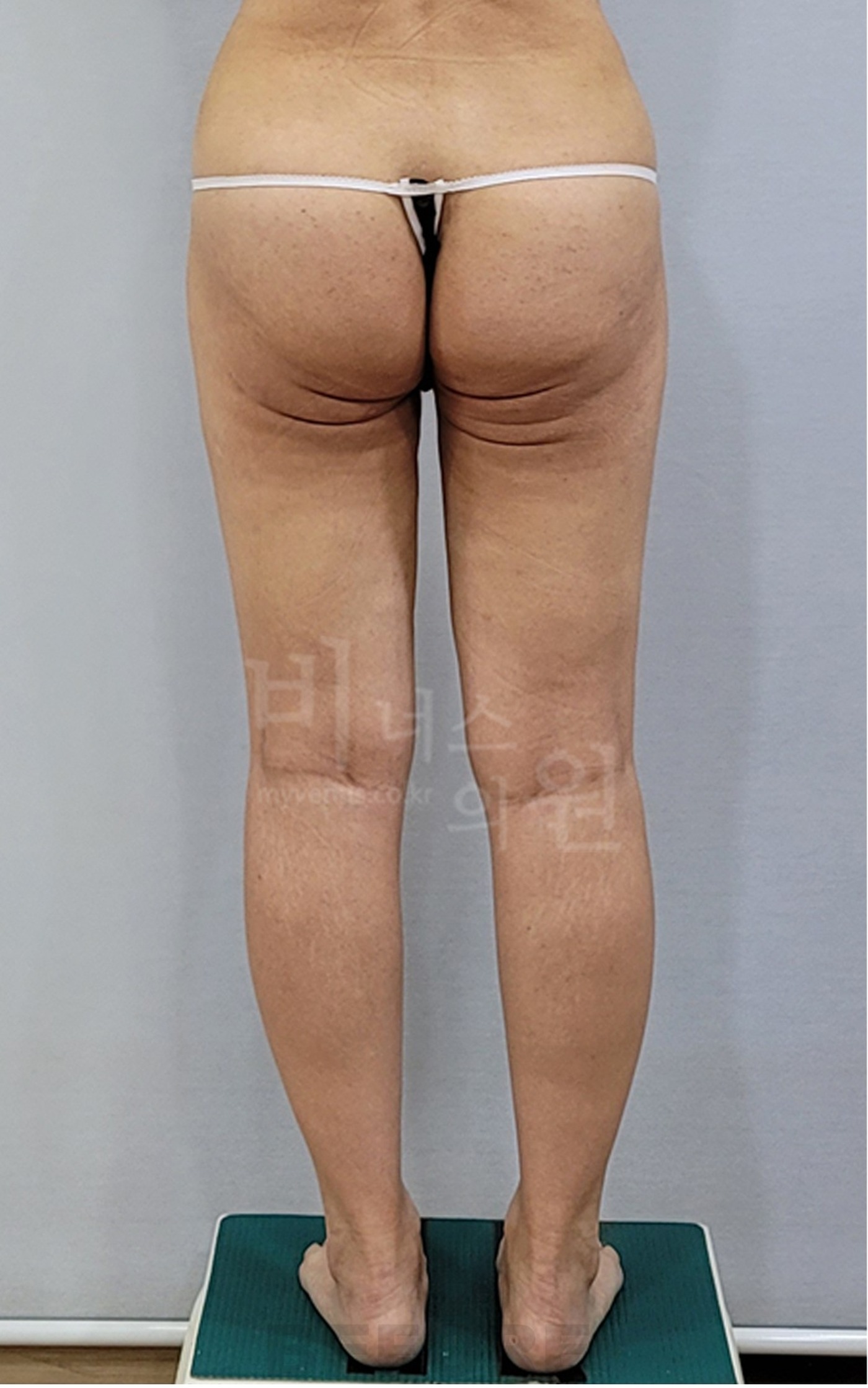 엉덩이축소 지방흡입 수술 전 후면 클로즈업 비너스의원