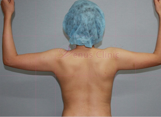 팔 지방흡입 수술 전 후면