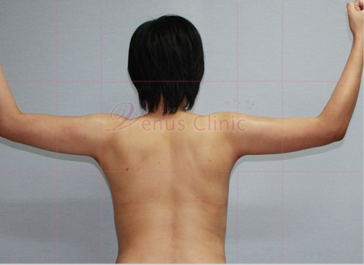 팔 지방흡입 수술 후 후면