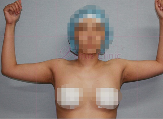 팔 지방흡입 수술 전 정면