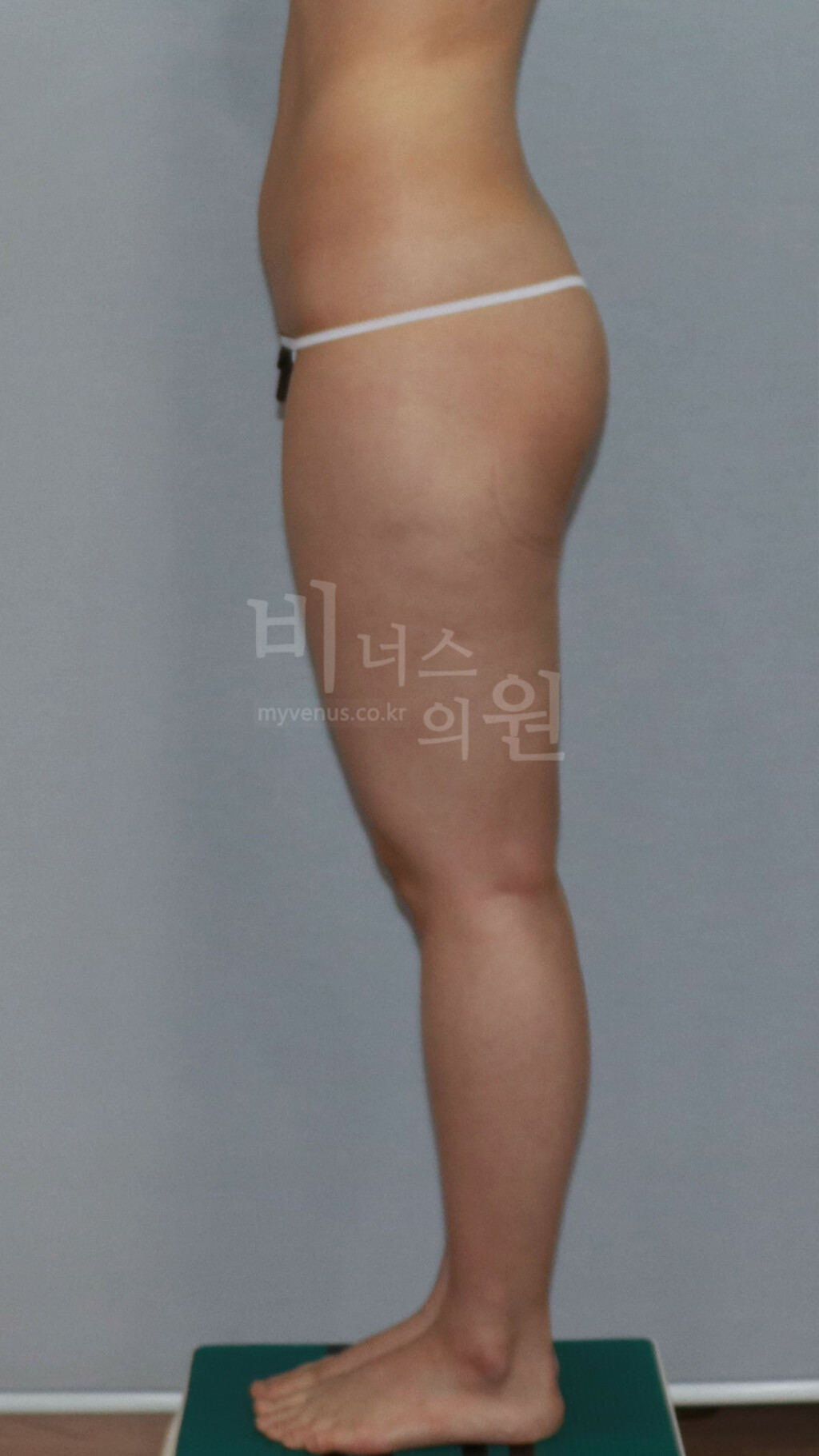 허벅지 지방흡입 수술 전 측면 비너스의원