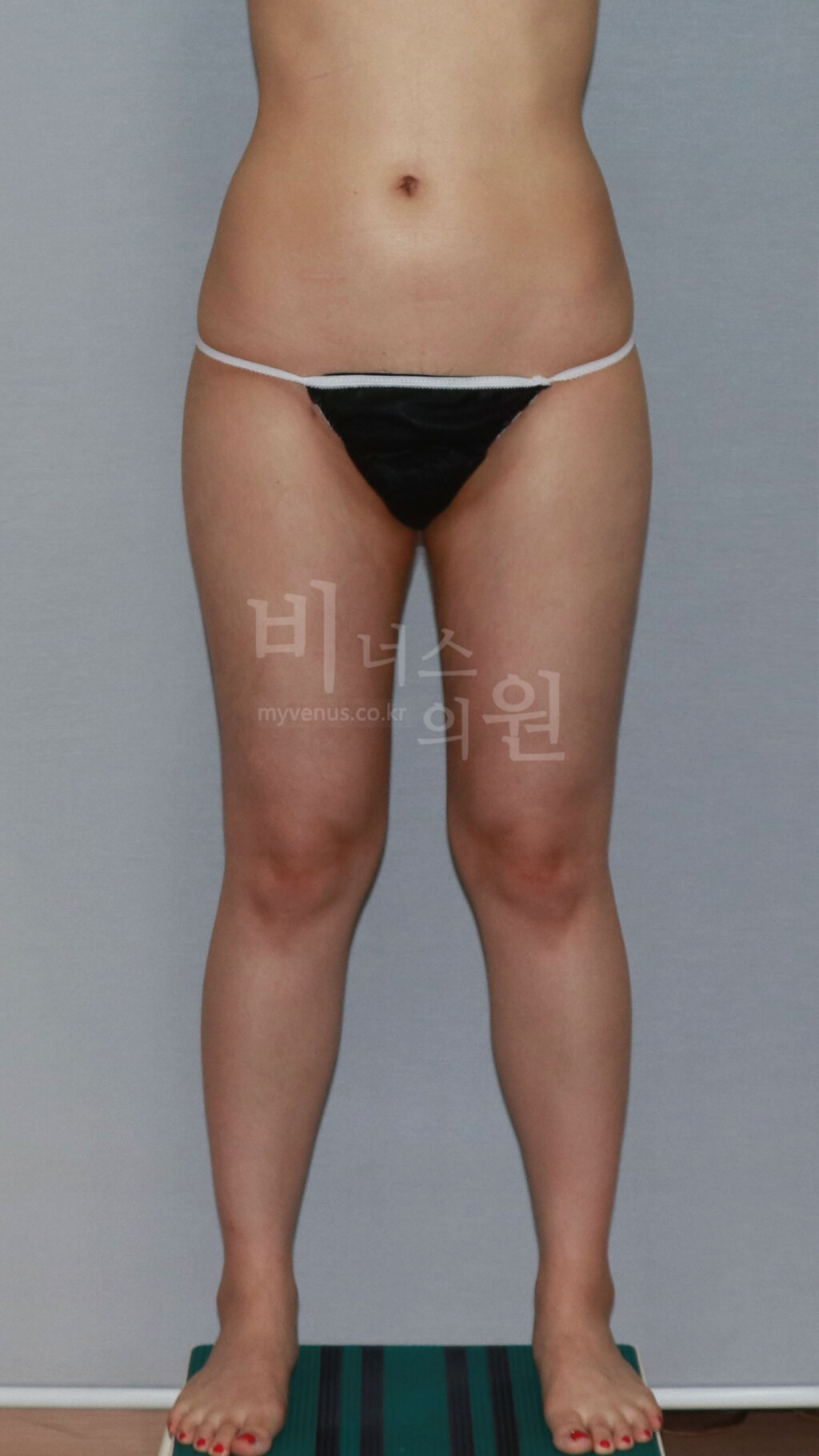 허벅지 지방흡입 수술 후 정면 비너스의원
