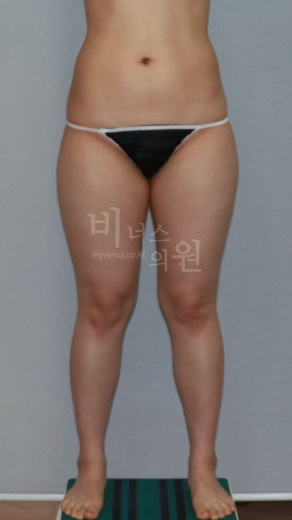 허벅지 지방흡입 수술 전 정면 비너스의원