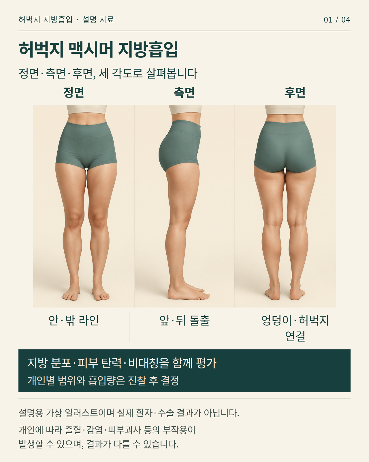 허벅지 맥시머 지방흡입의 정면·측면·후면 평가를 설명하는 가상 일러스트 인포그래픽