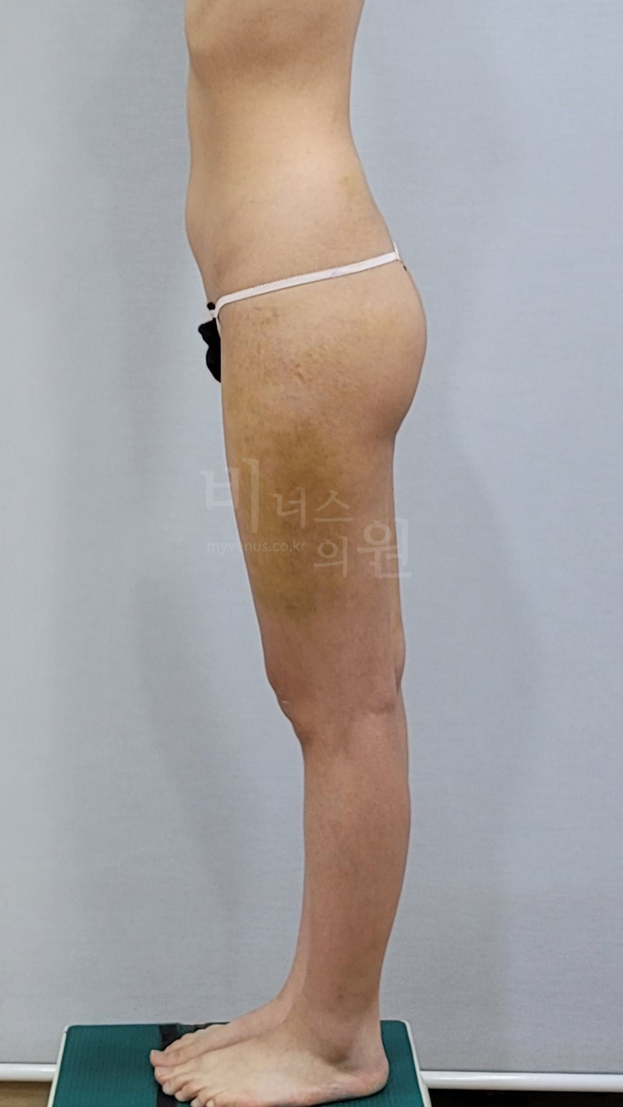 허벅지 지방흡입 수술 후 우측면 비너스의원
