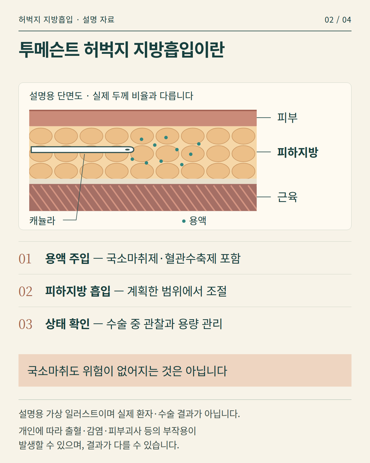 투메슨트 용액 주입과 피하지방 흡입 원리를 설명하는 가상 단면 인포그래픽