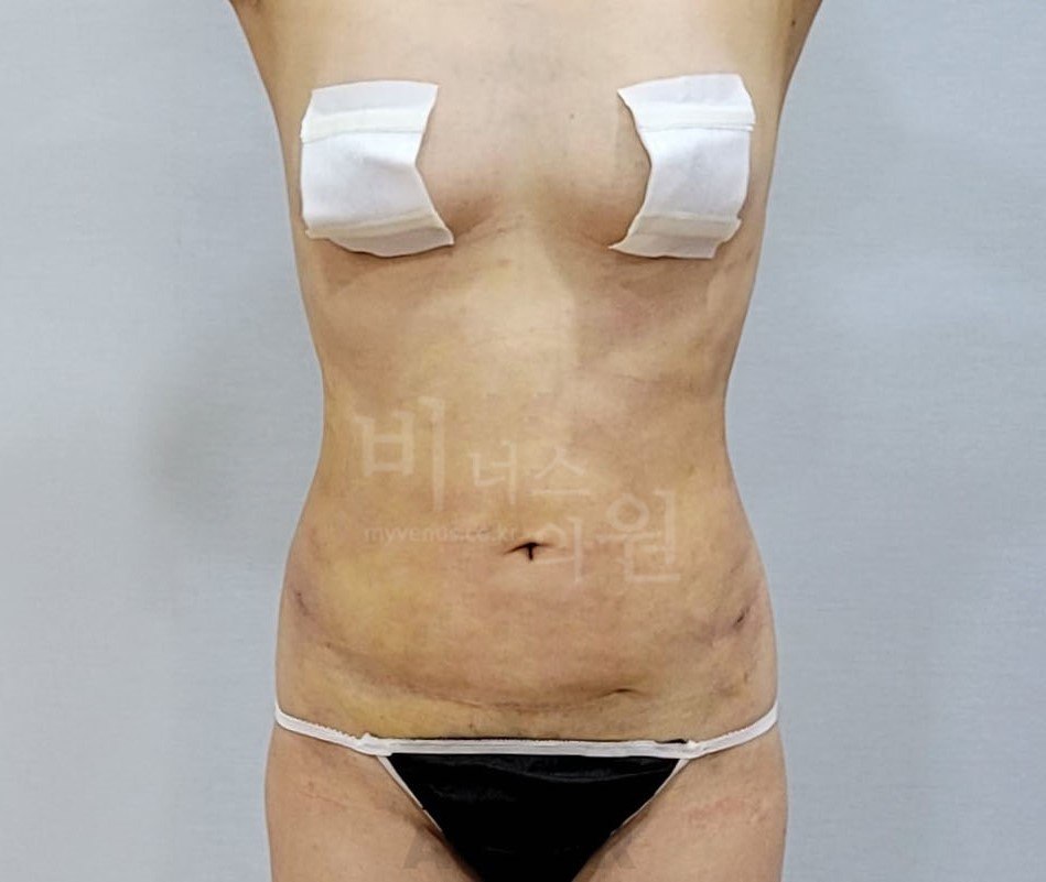 복부 지방흡입 전후사진 비너스의원