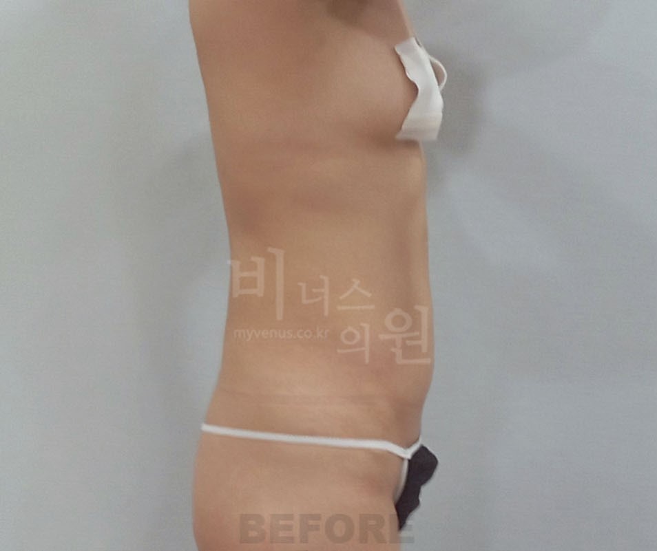 복부지방흡입_3 - 복사본.jpg