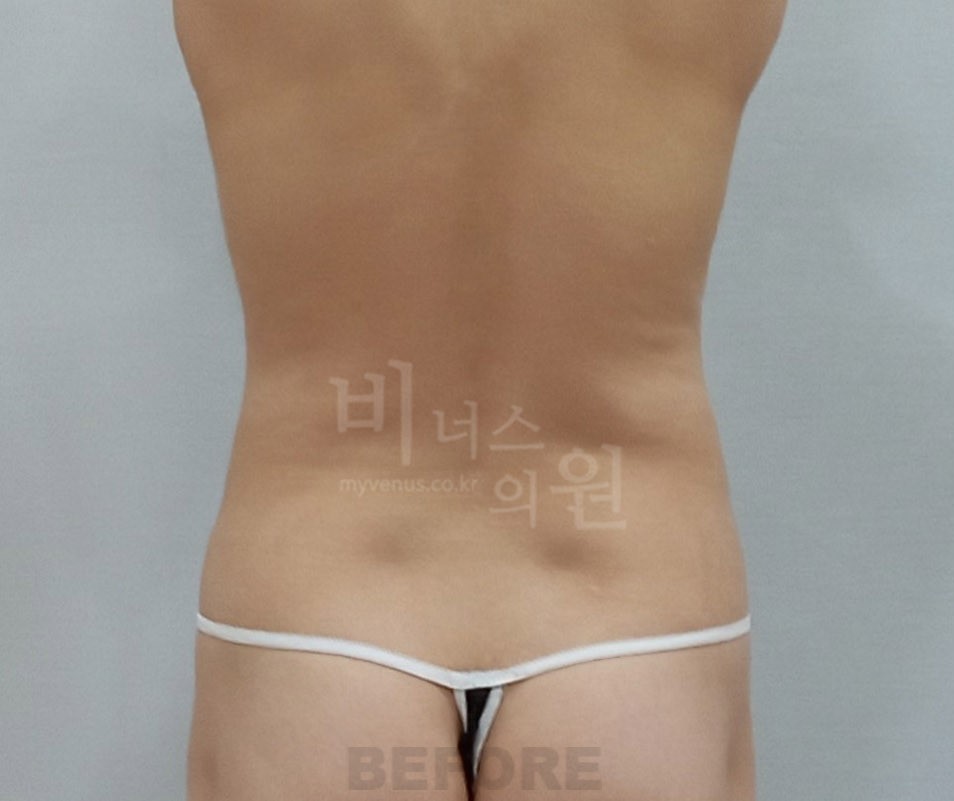 복부옆구리지방흡입_4 - 복사본.jpg