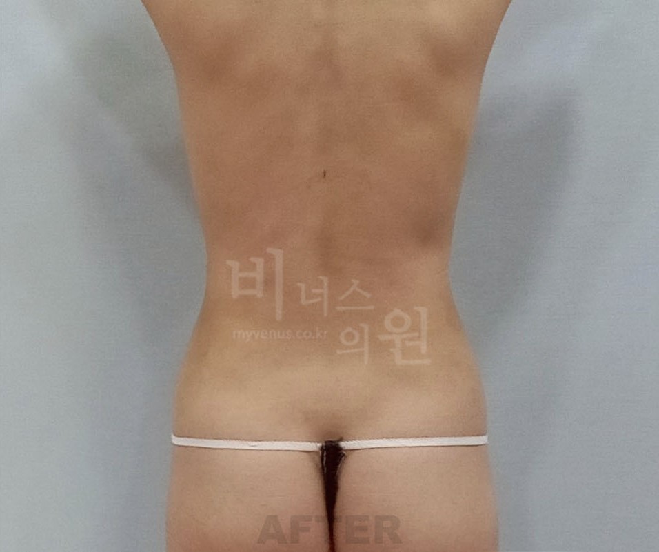 복부지방흡입_4.jpg