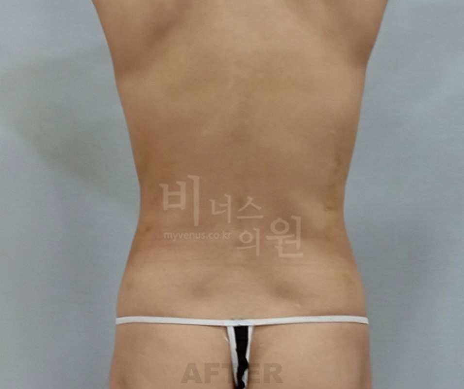 복부옆구리지방흡입_4.jpg