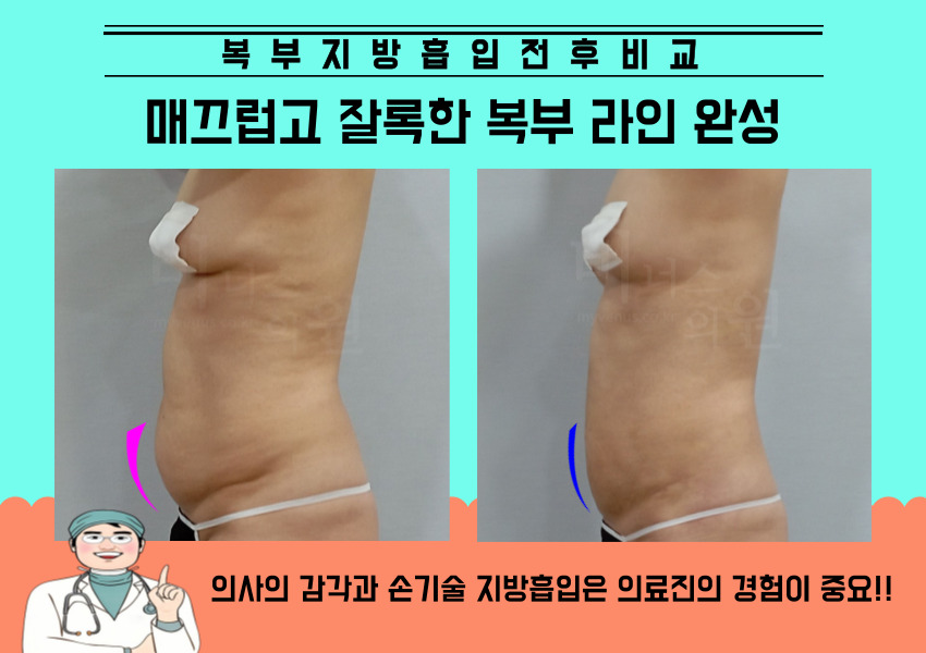 복부지방흡입.jpg