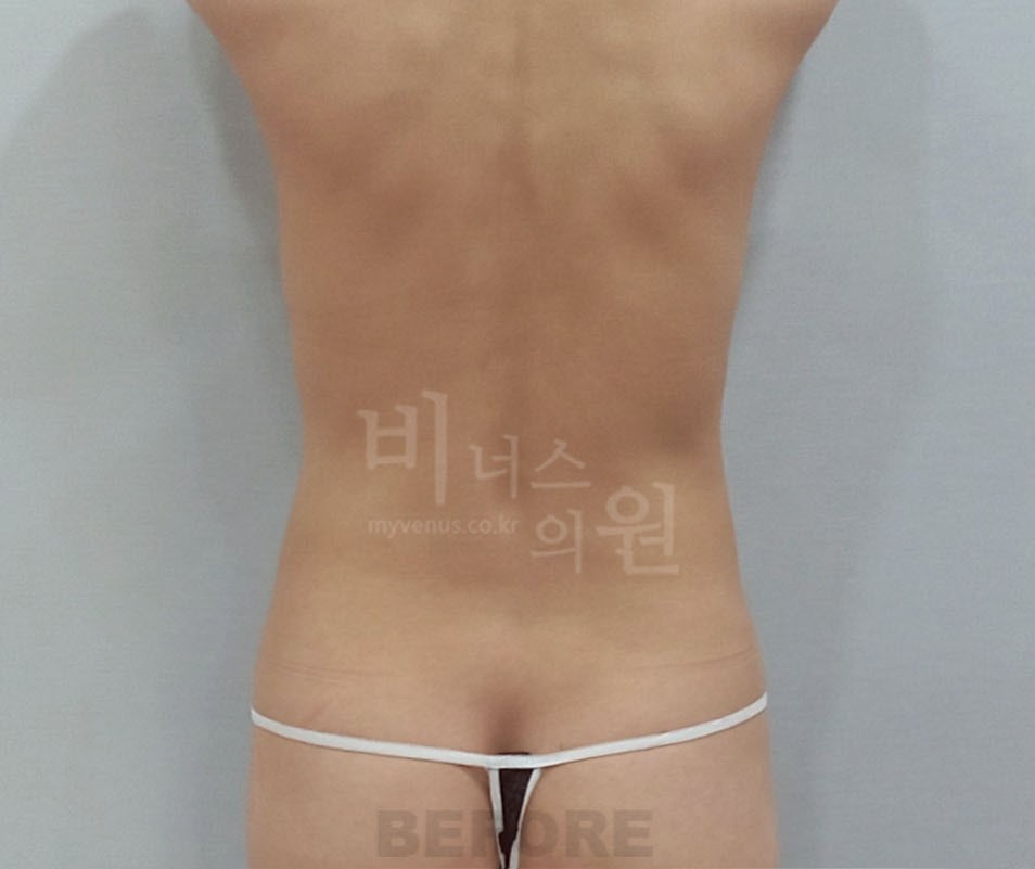 복부지방흡입_4 - 복사본.jpg