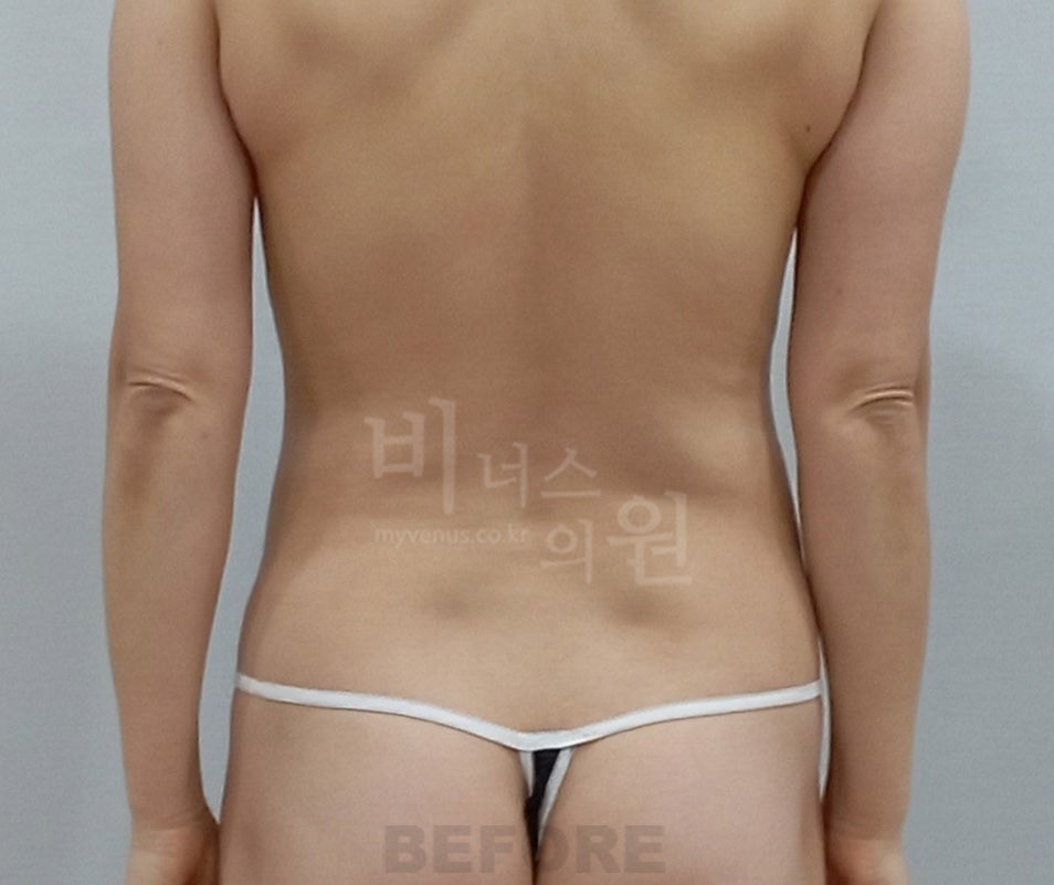 복부옆구리지방흡입_3 - 복사본.jpg