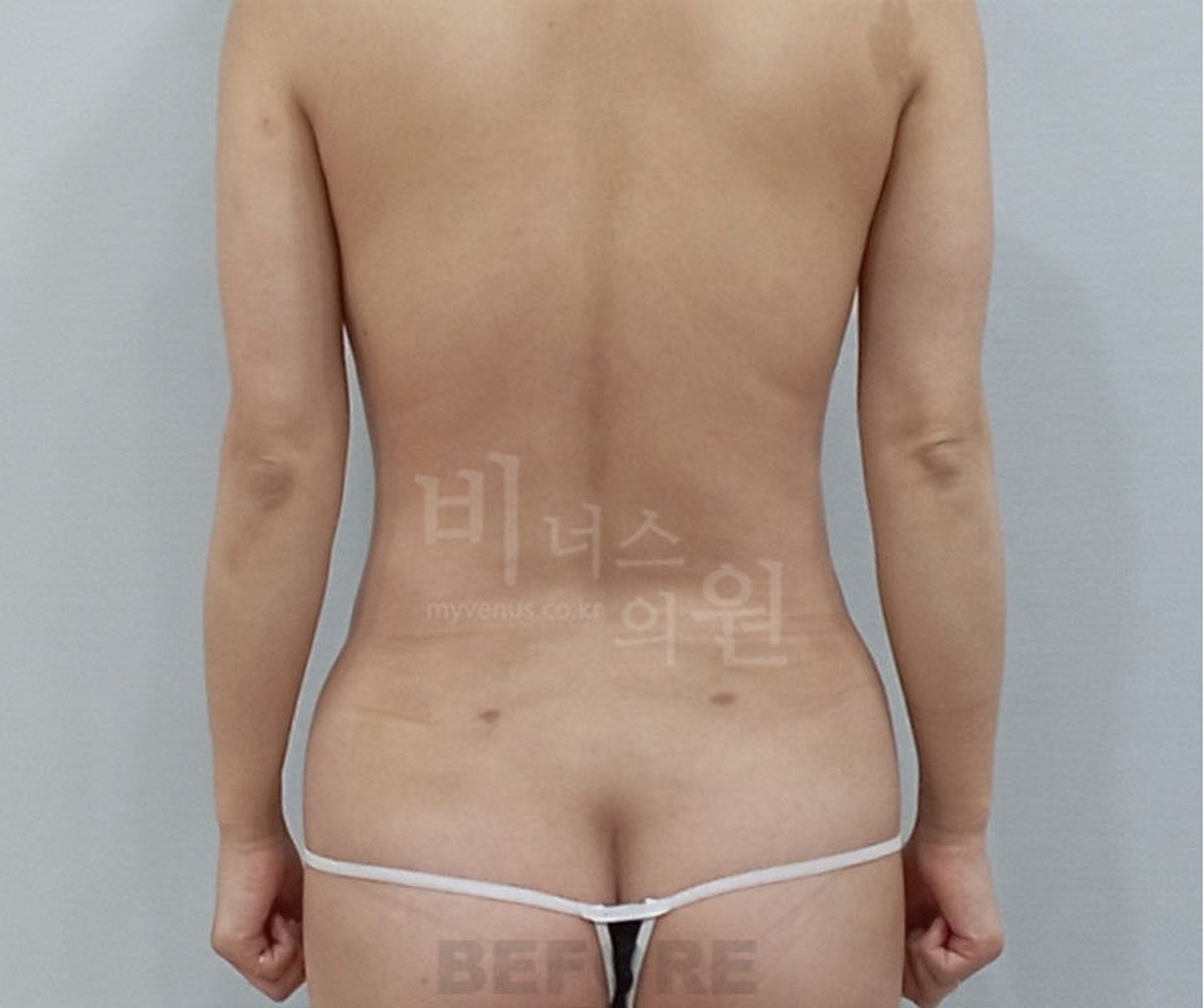 가슴축소수술 수술 전 후면 등 모습