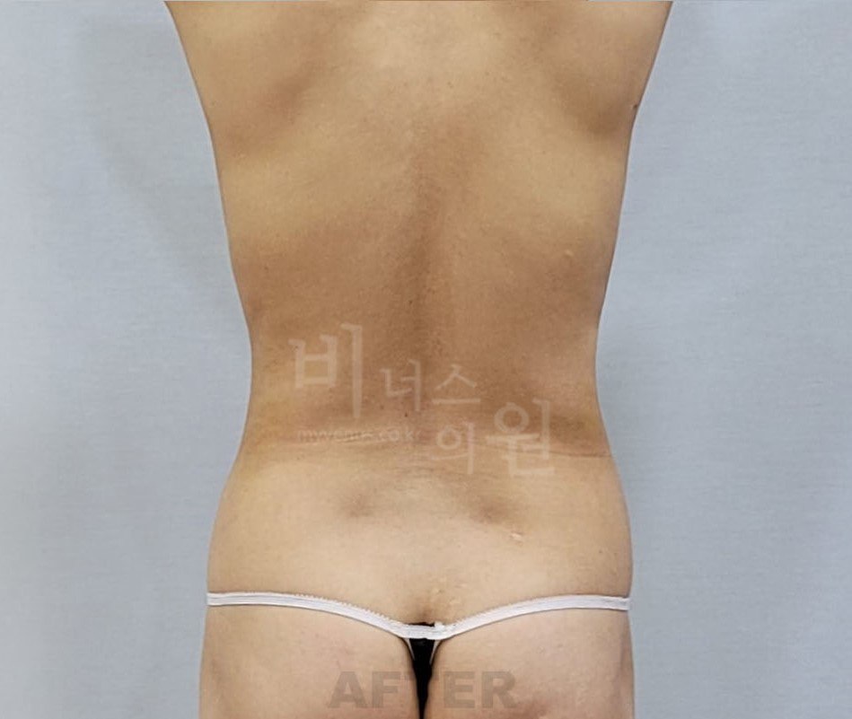 복부 지방흡입 수술 후