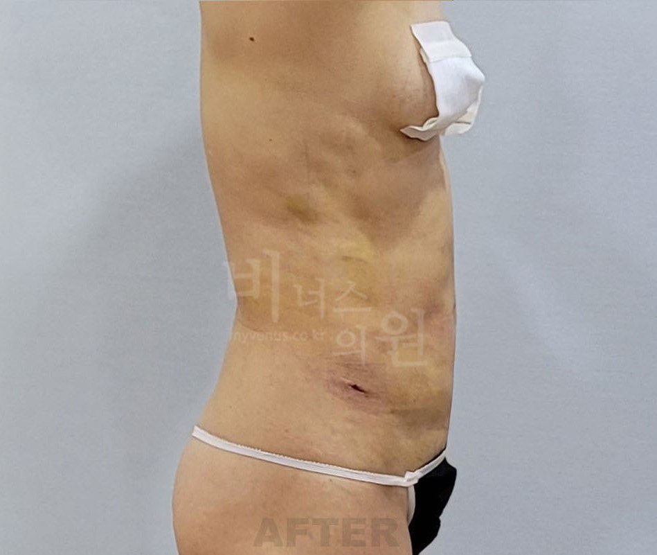 복부 지방흡입 수술 후