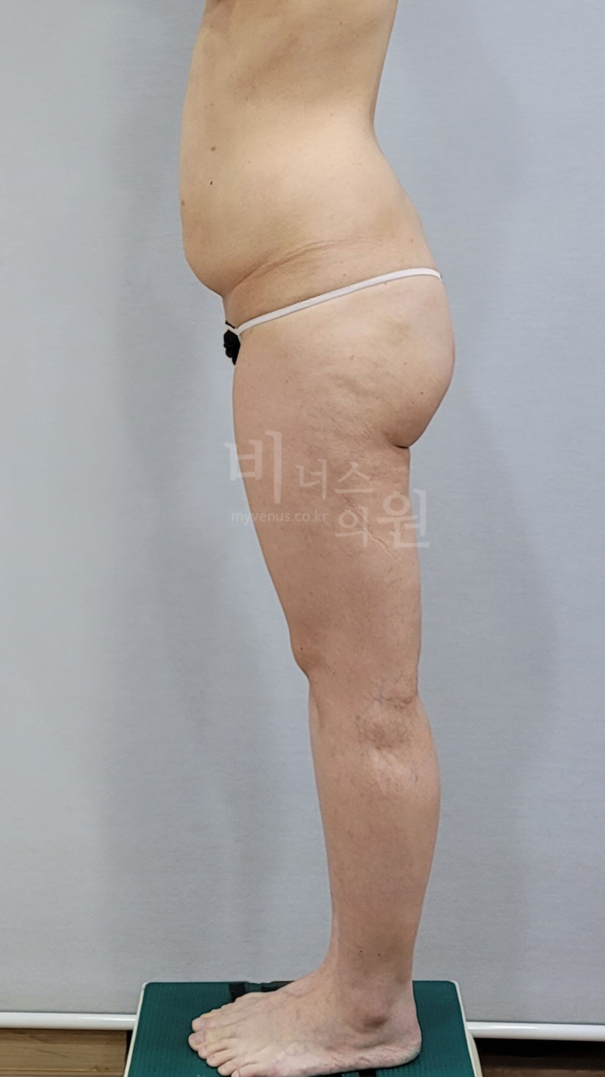 엉덩이축소 지방흡입 수술 전 우측 비너스의원