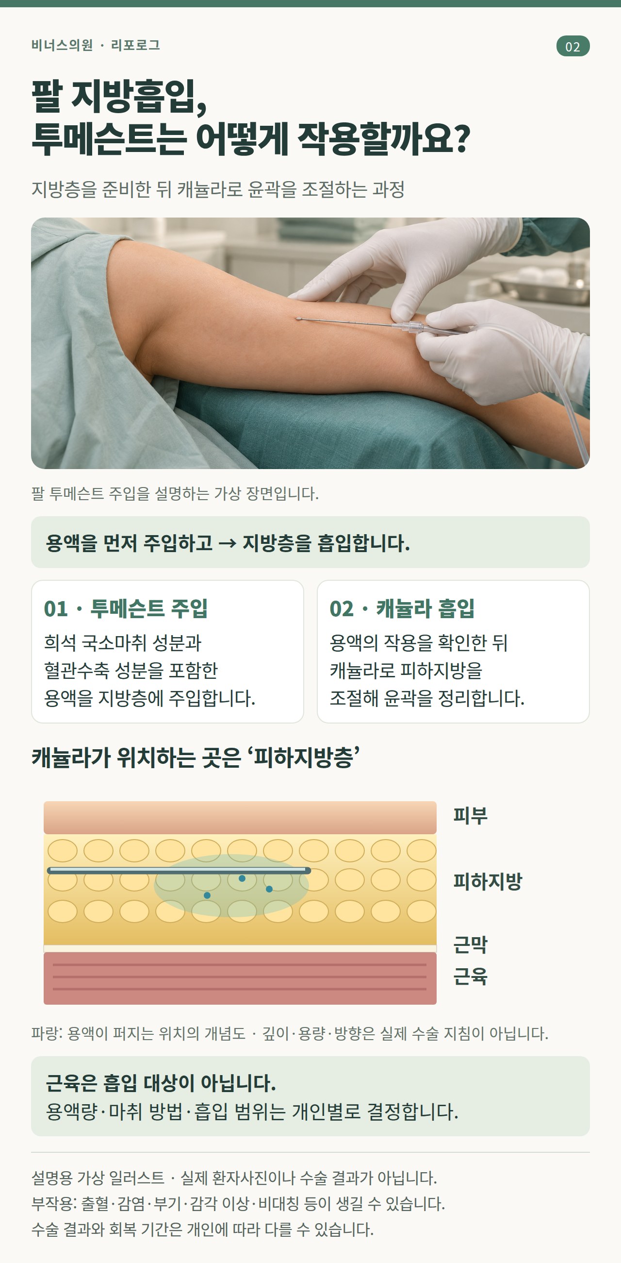 투메슨트 주입과 피하지방층 캐뉼라 흡입 원리를 설명하는 가상 일러스트