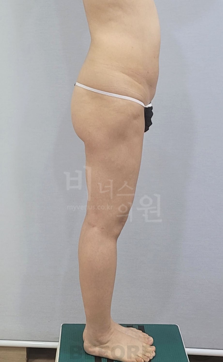 엉덩이 지방흡입 수술 전 반대쪽 측면 비너스의원