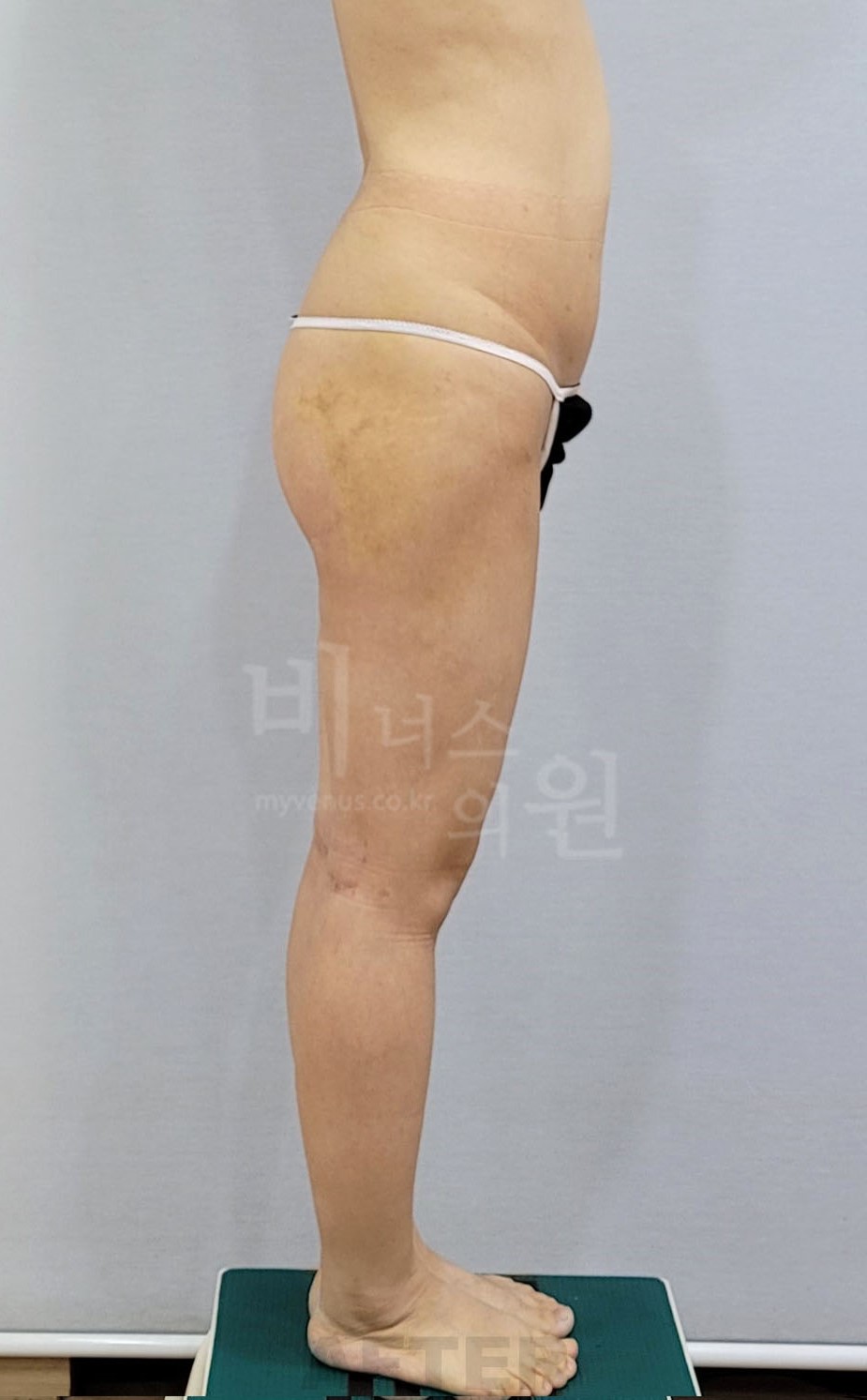엉덩이 지방흡입 수술 후 반대쪽 측면 비너스의원