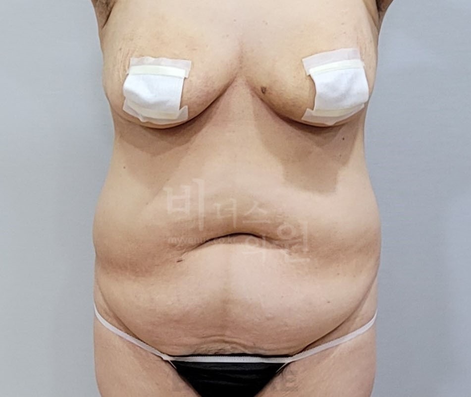 복부 지방흡입 수술 전 정면 비너스의원