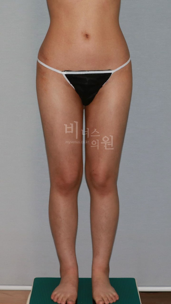 허벅지 지방흡입 수술 후 정면 비너스의원