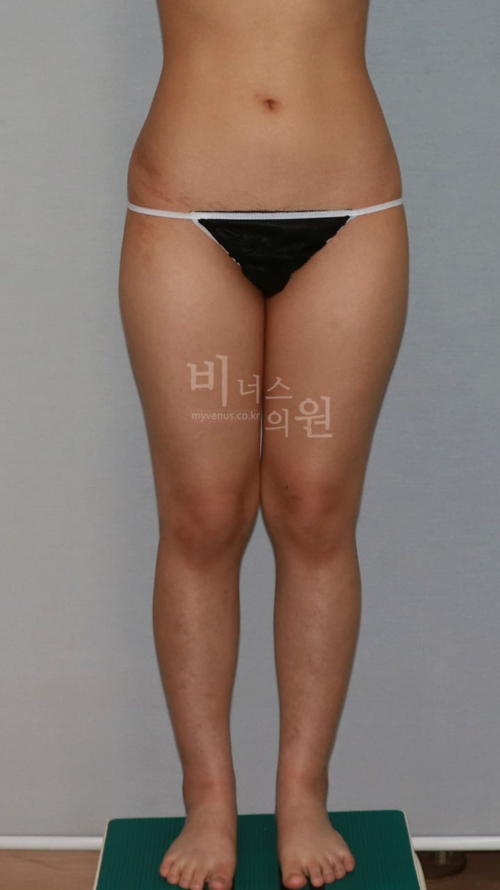 허벅지 지방흡입 수술 전 정면 비너스의원
