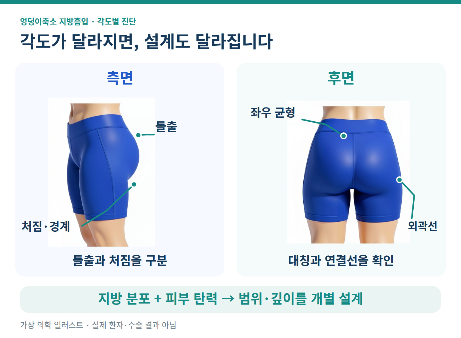 가상 의학 인포그래픽: 측면의 돌출·처짐과 후면의 좌우 균형·외곽선을 함께 평가하는 엉덩이축소 설계