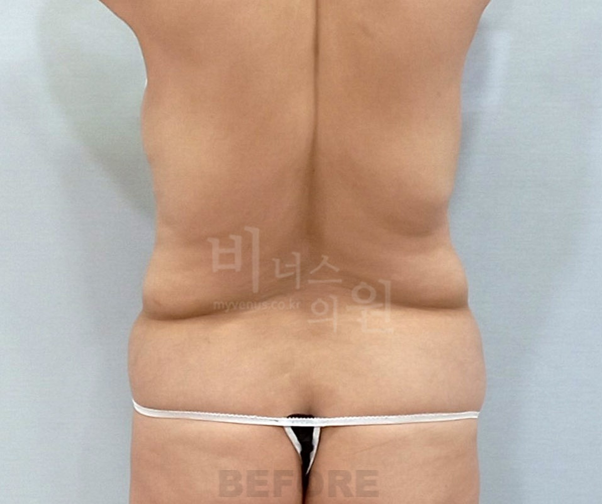 복부 지방흡입 수술 전 후면 비너스의원