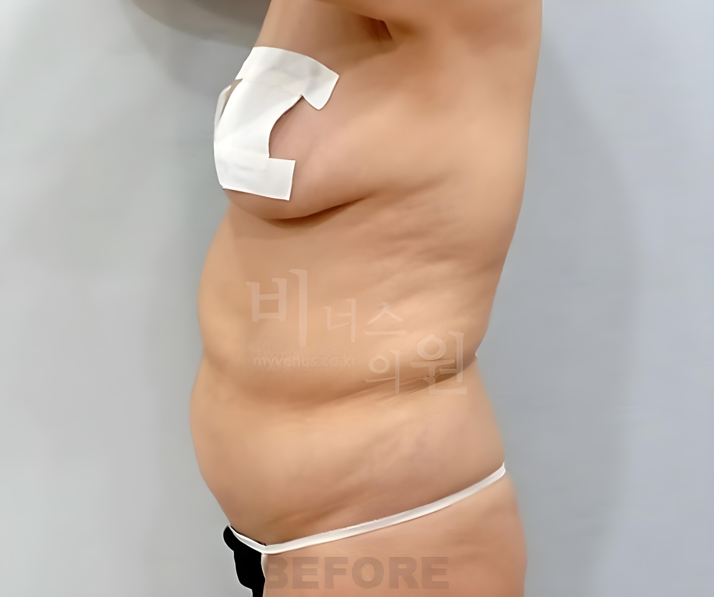 복부 지방흡입 수술 전 측면 비너스의원