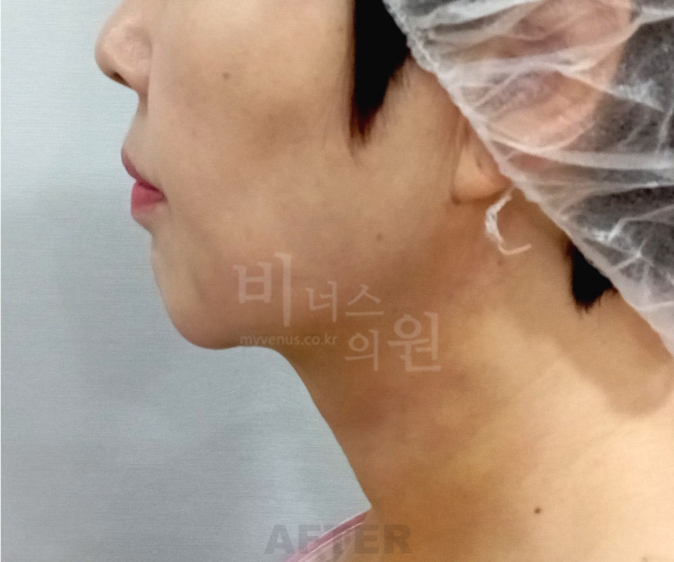 이중턱 목 지방흡입 수술 후 측면 비너스의원