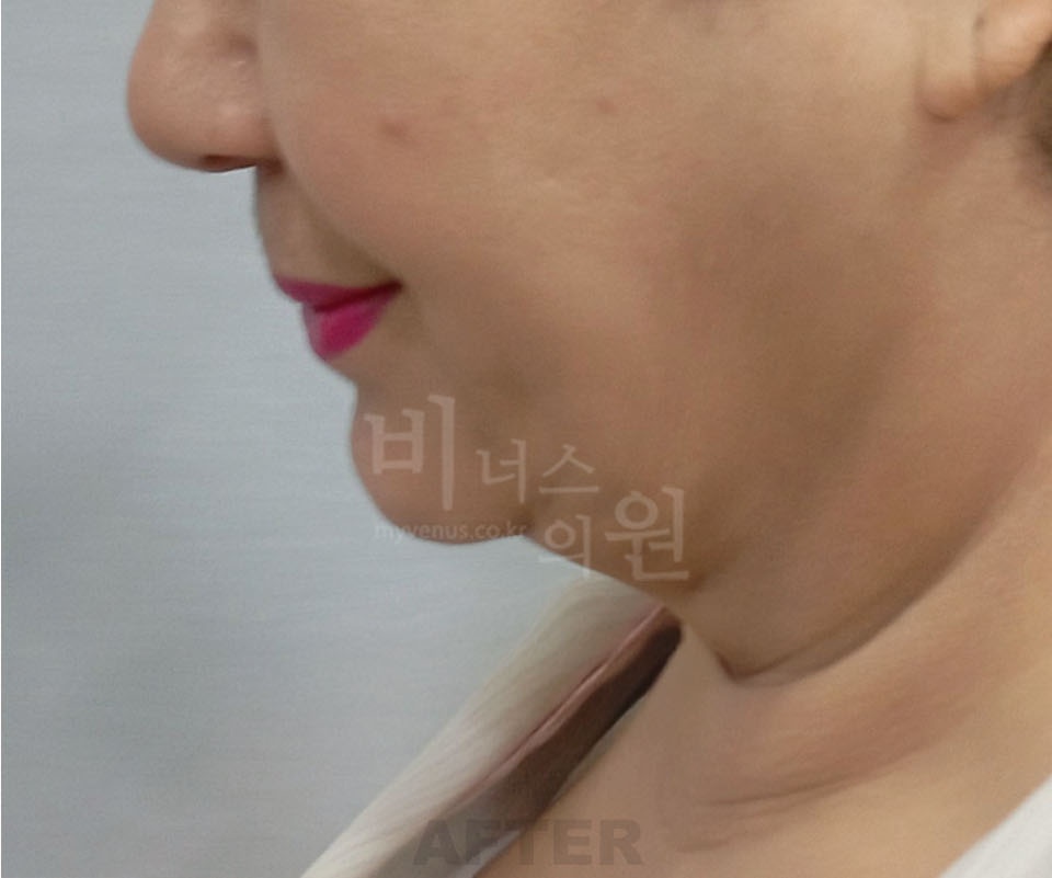 턱지방흡입 수술 후 측면 비너스의원