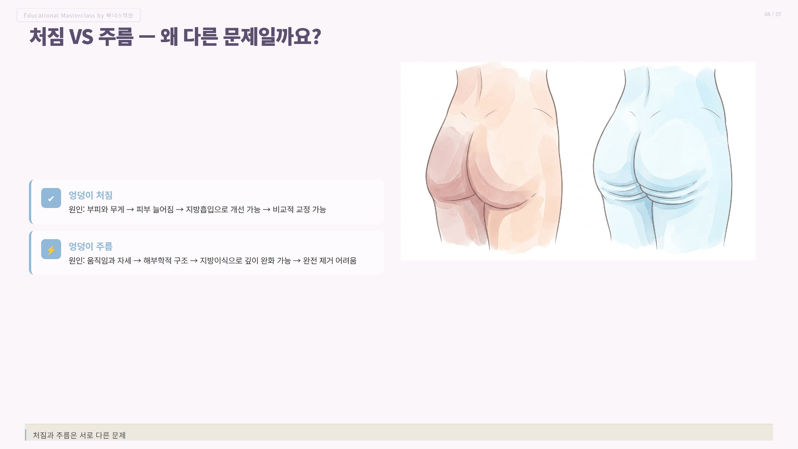 엉덩이이중주름_3.jpg