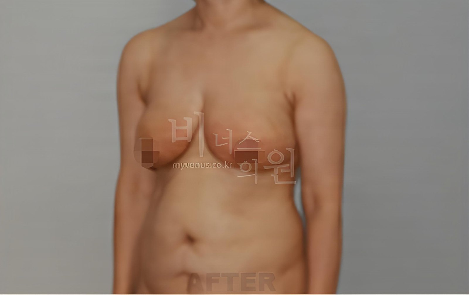 유방하수 가슴 지방흡입 수술 후 45도 측면 비너스의원