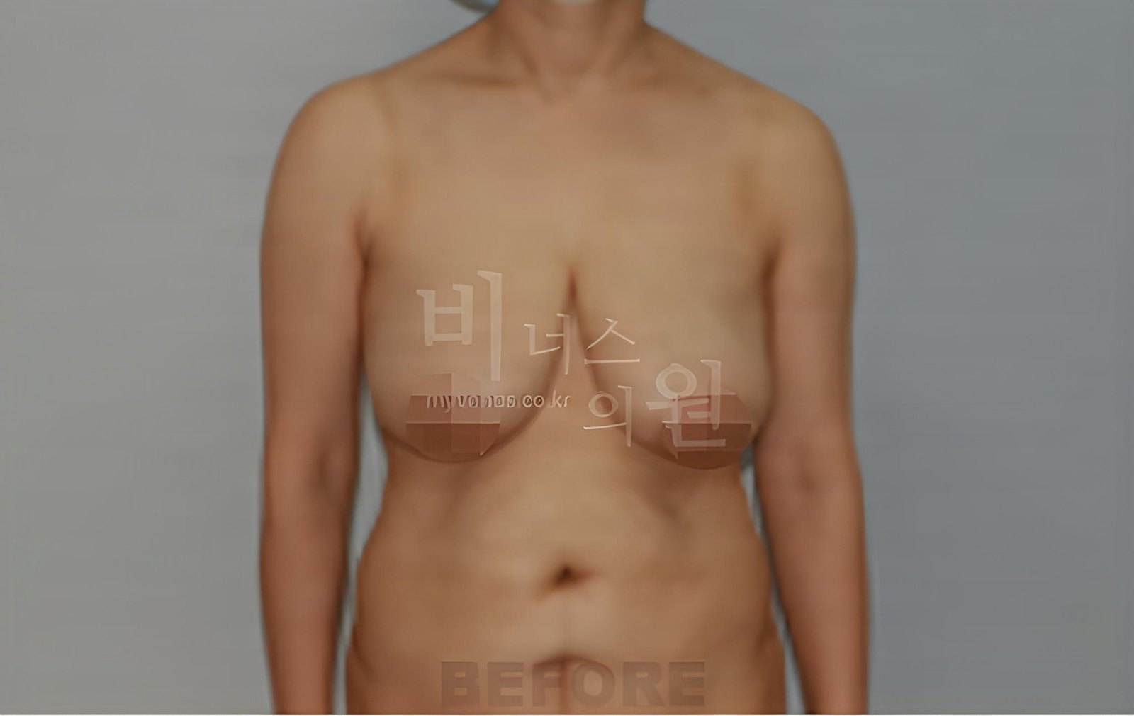 유방하수 가슴 지방흡입 수술 전 정면 비너스의원