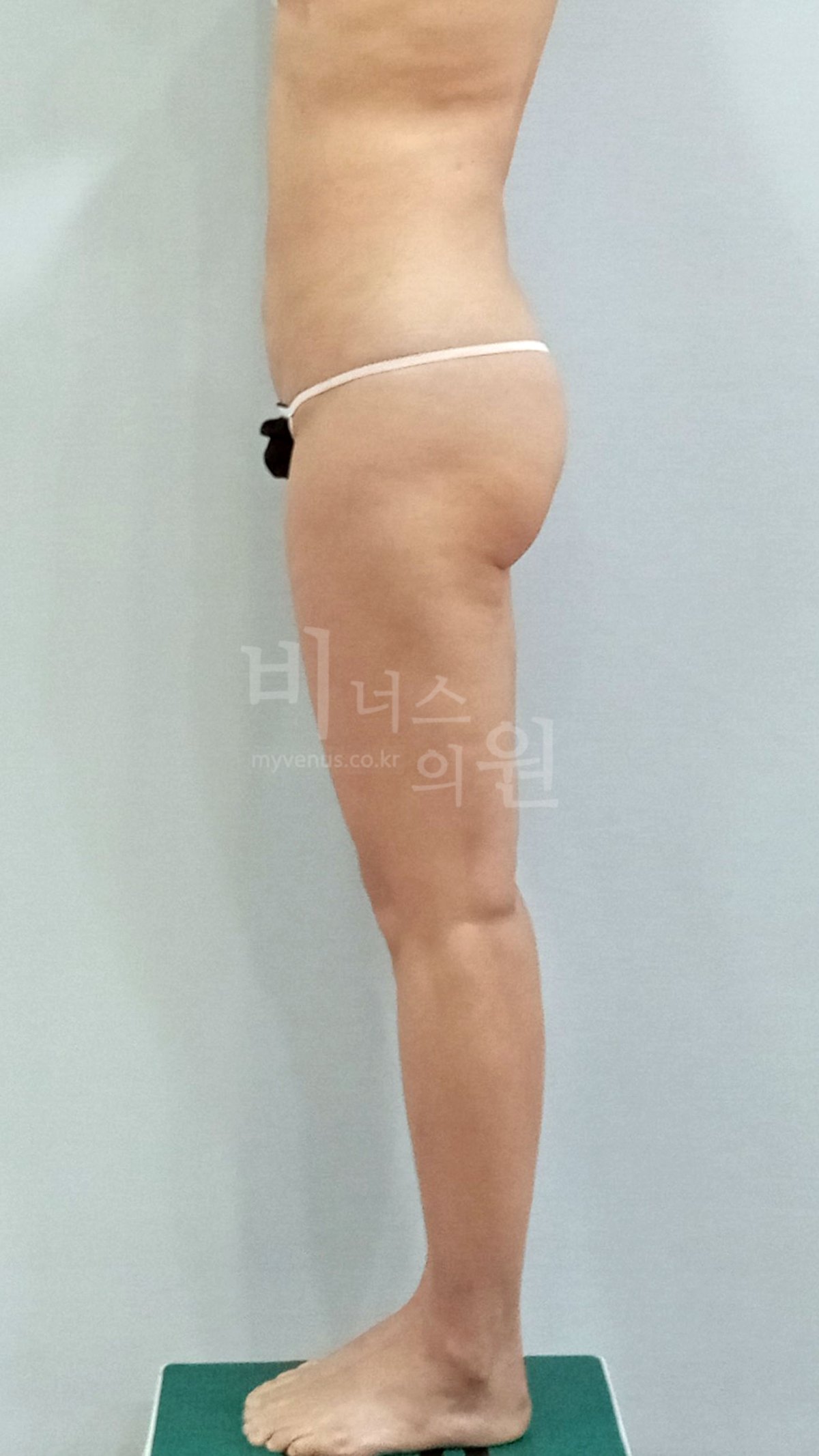엉덩이 볼륨업 지방흡입 수술 전 측면 비너스의원