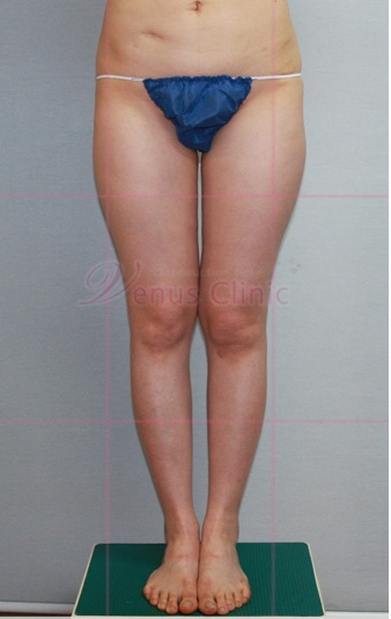 엉덩이 볼륨업 지방흡입 수술 전 정면 하반신 체형 비너스의원