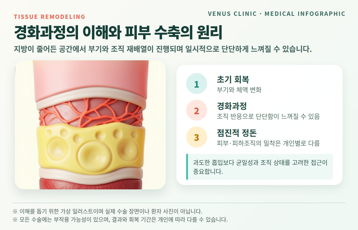 지방흡입 후 경화과정과 피부 수축 원리를 설명하는 가상 의료 인포그래픽
