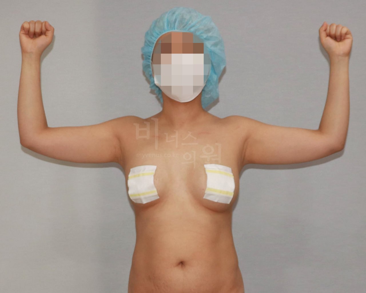 팔뚝 지방흡입 정면 수술 전