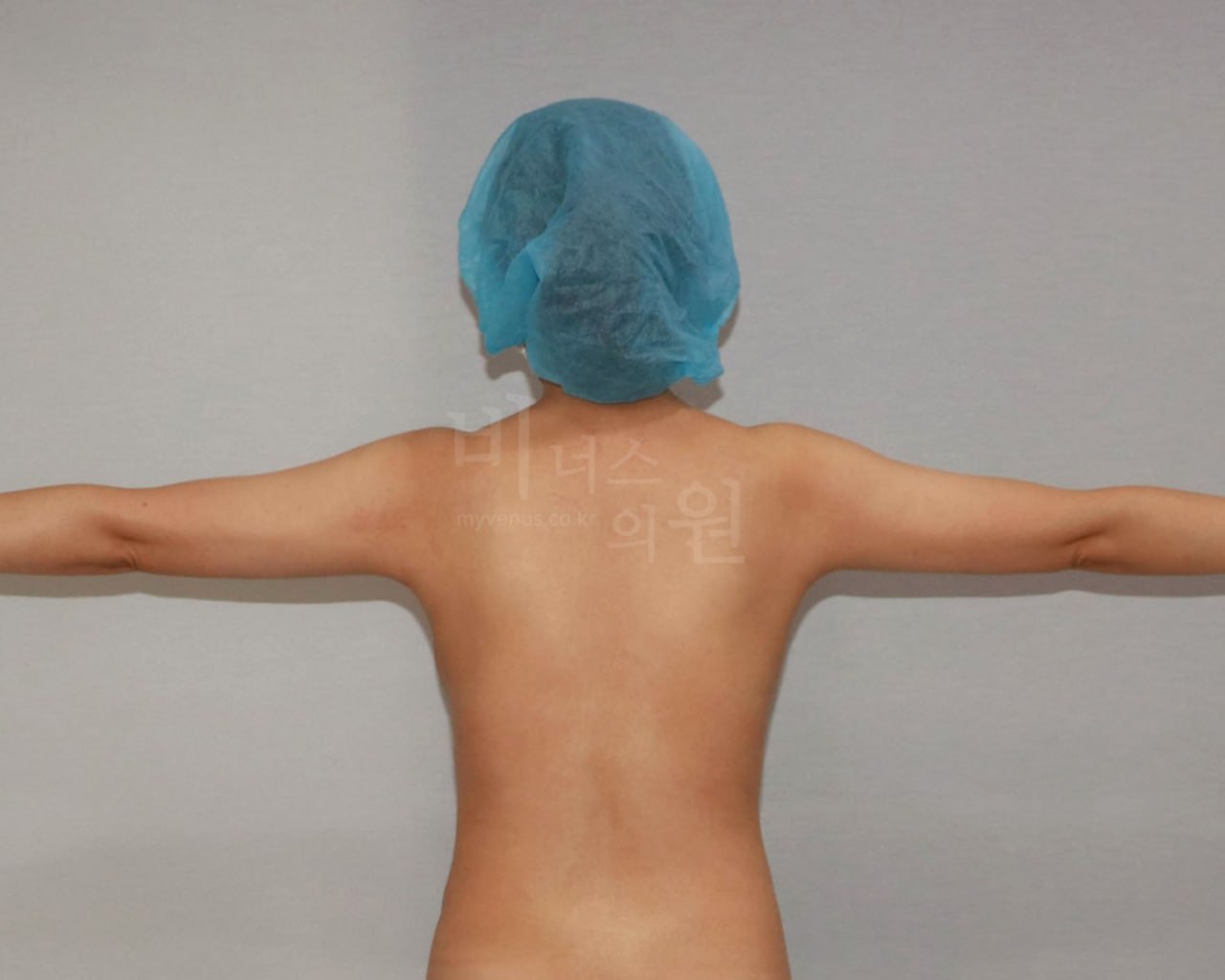 팔뚝 지방흡입 후면 수술 후
