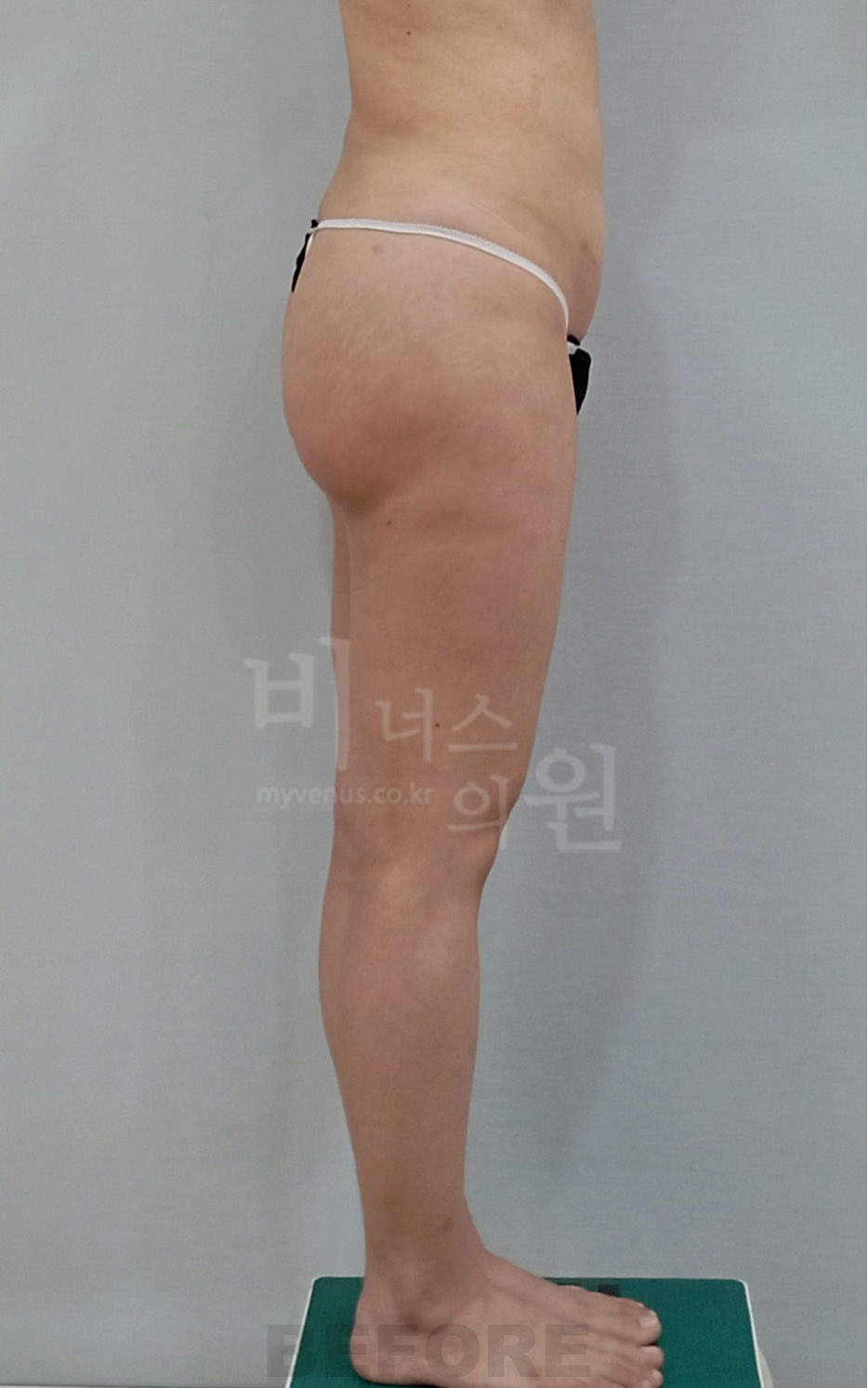 엉덩이처짐 지방흡입 수술 전 반대쪽 측면 비너스의원