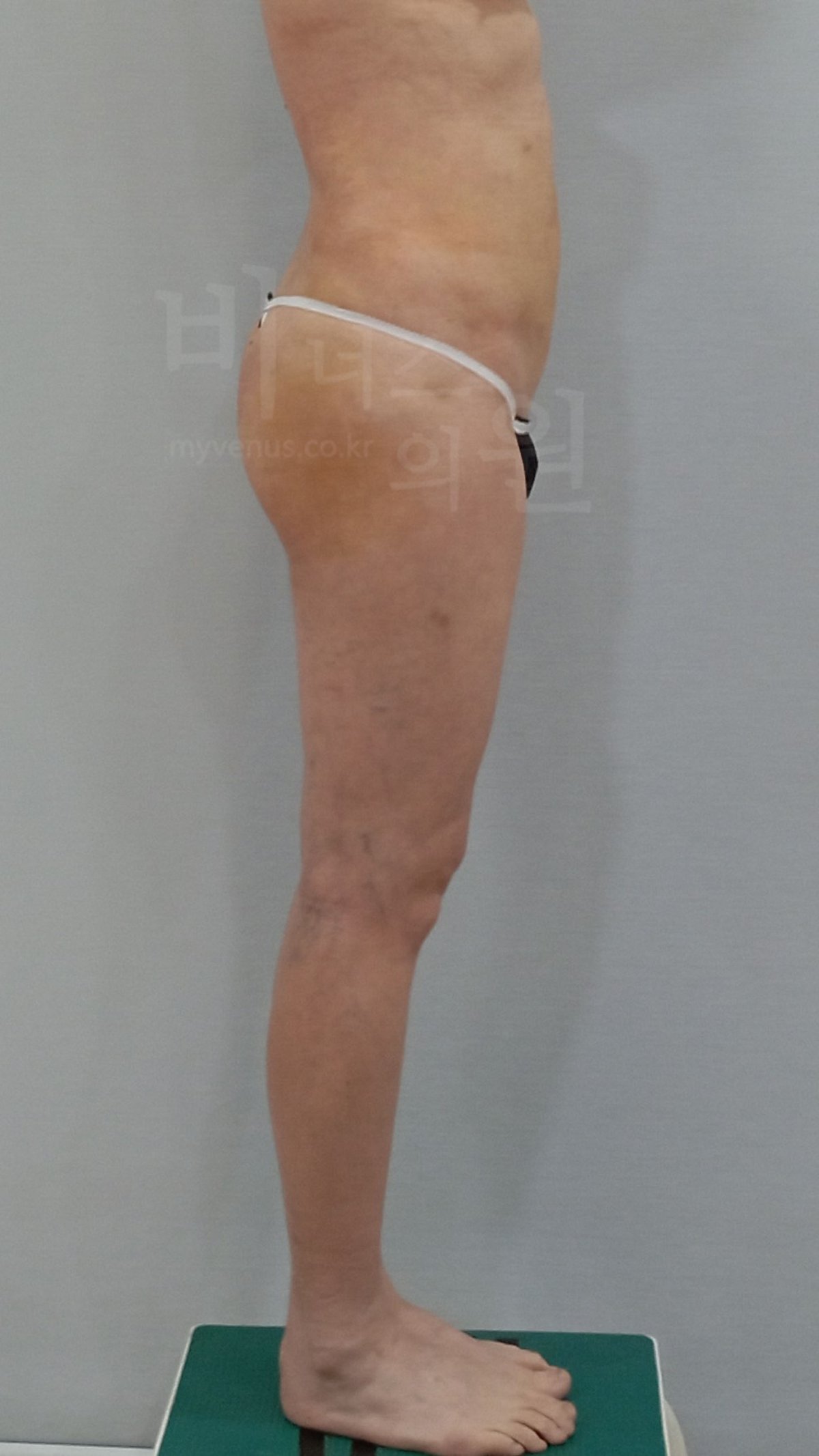 엉덩이축소 지방흡입 수술 후 좌측면 비너스의원