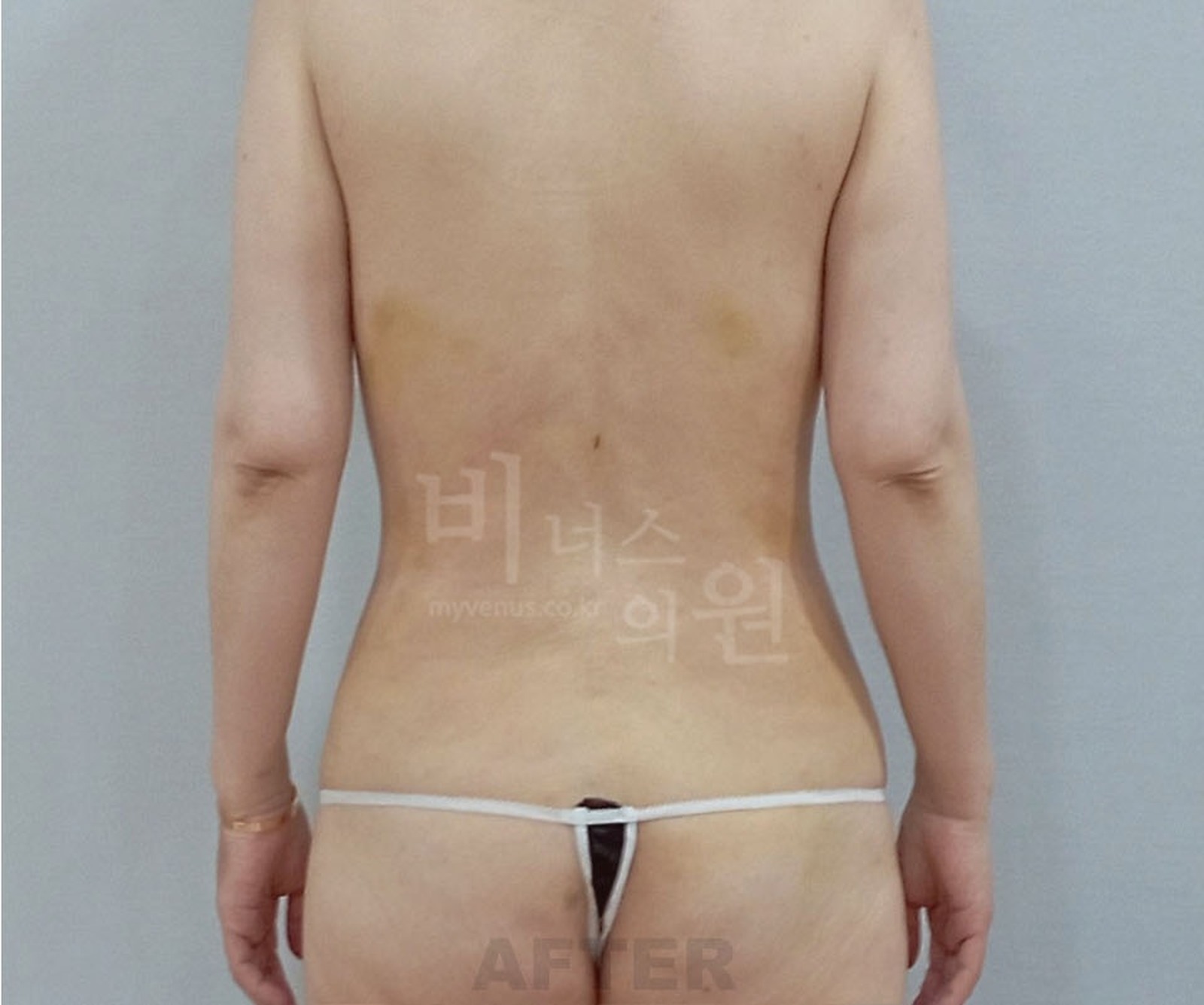 복부 지방흡입 수술 후 1주 후면 비너스의원