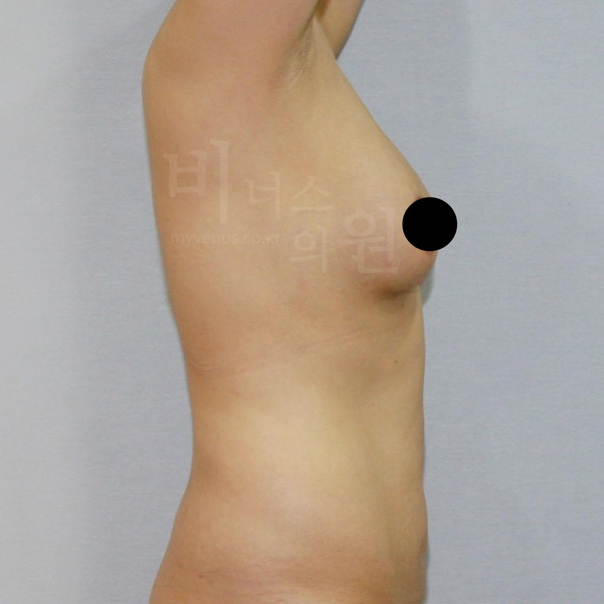 가슴축소 지방흡입 수술 후 측면